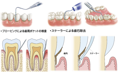 歯周病の検査と治療