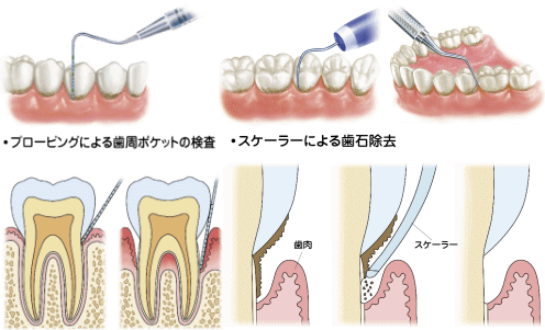 歯石取り