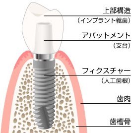 インプラントの構造