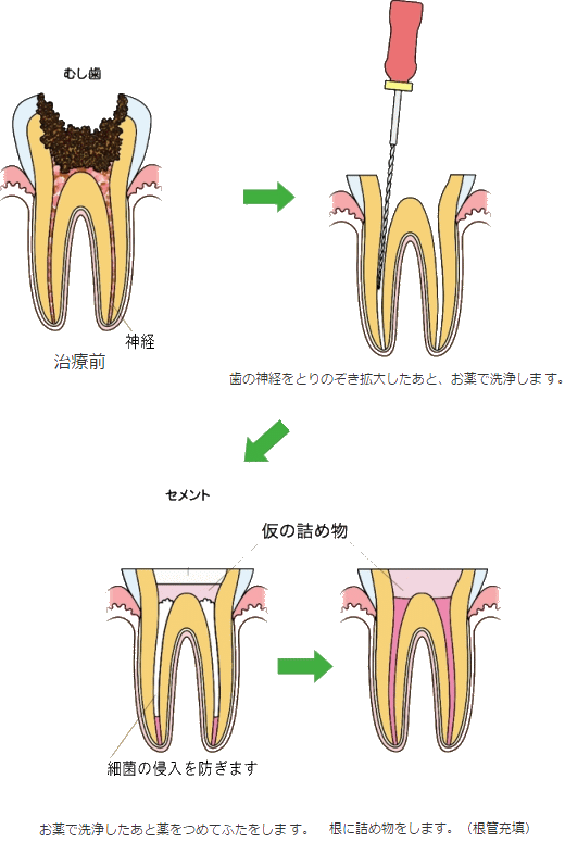 歯内療法（根管治療）