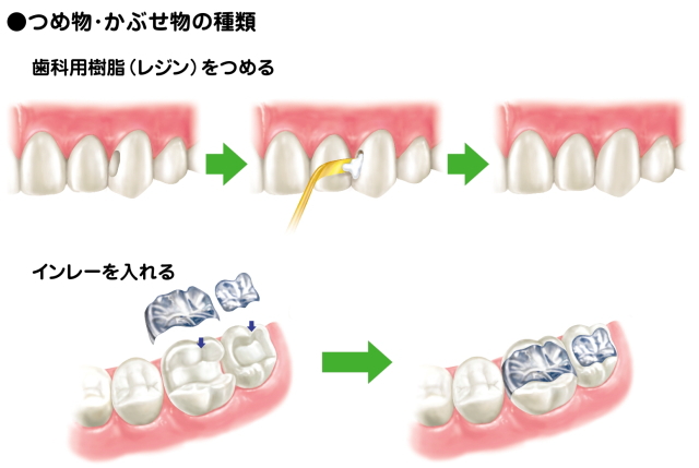 詰め物・かぶせ物の種類