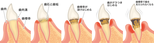 歯周病の進行