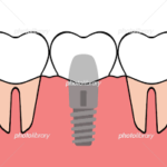 インプラントをする前に