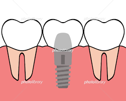 インプラントをする前に
