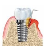 インプラントの歯周病「インプラント周囲炎」を予防しましょう！