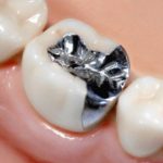 高騰している保険の銀歯治療の欠点とは？