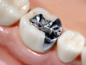 高騰している保険の銀歯治療の欠点とは？