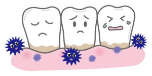 お口の健康を守るための大切な習慣：まちの歯科医院が解説する歯石除去治療