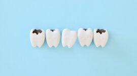 虫歯のイメージ