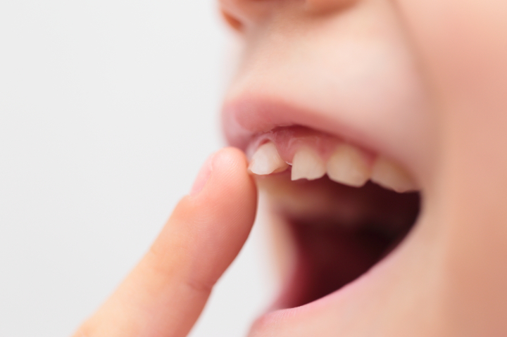 グラグラする歯を触る様子