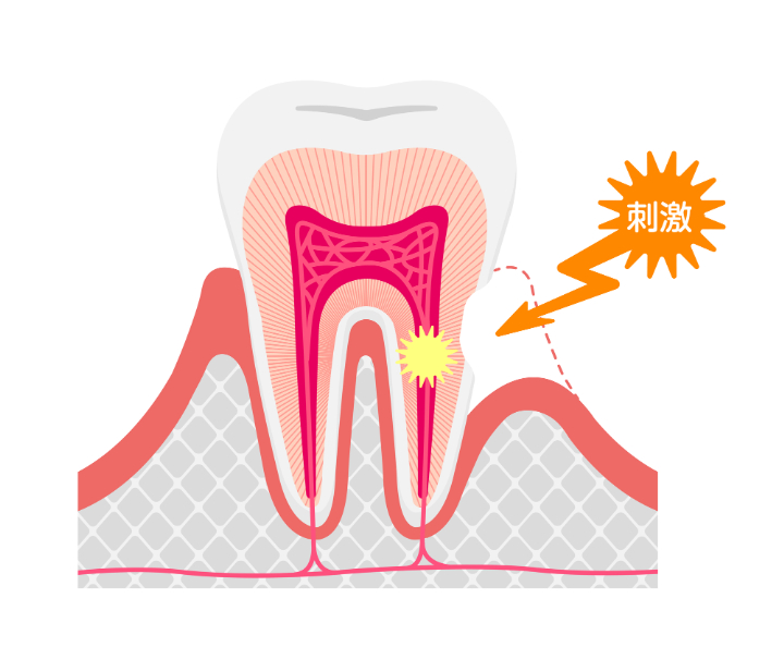 知覚過敏のメカニズム